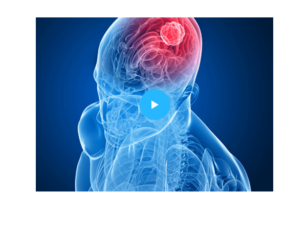 ali-erdem-yildirim-beyintumor_hover